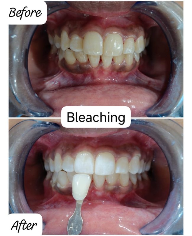 Before and after Teeth Bleaching treatment at Face-O-Max