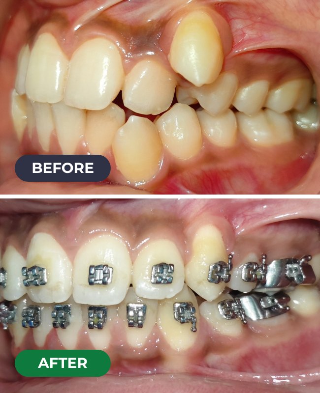 Before and after Braces treatment at Face-O-Max
