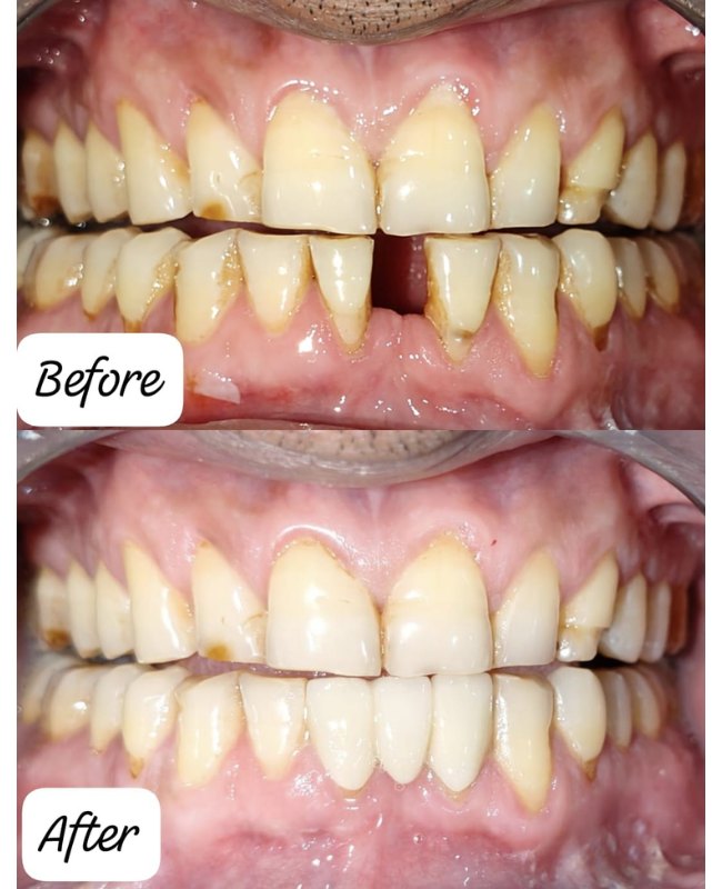 Before and after Dental Bridge treatment at Face-O-Max