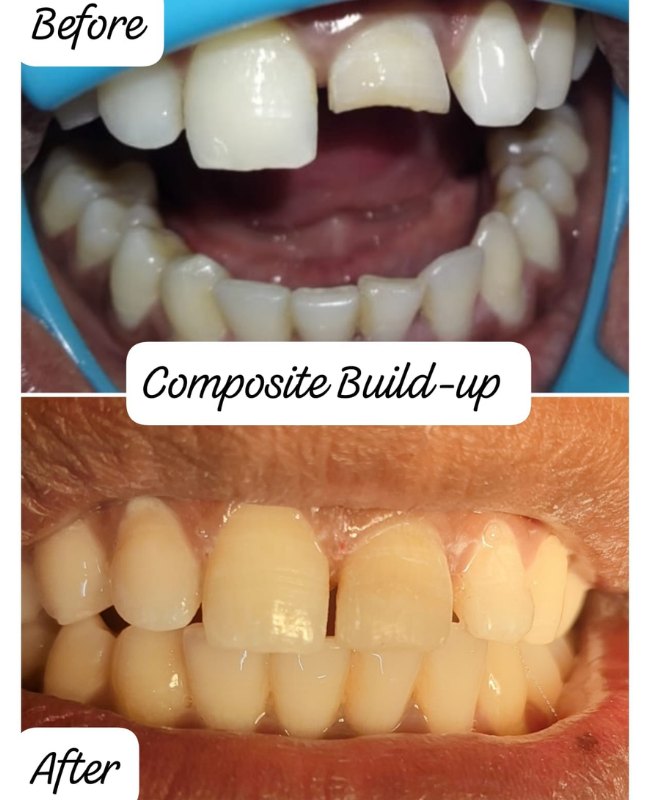 Before and after Crown Build-Up treatment at Face-O-Max