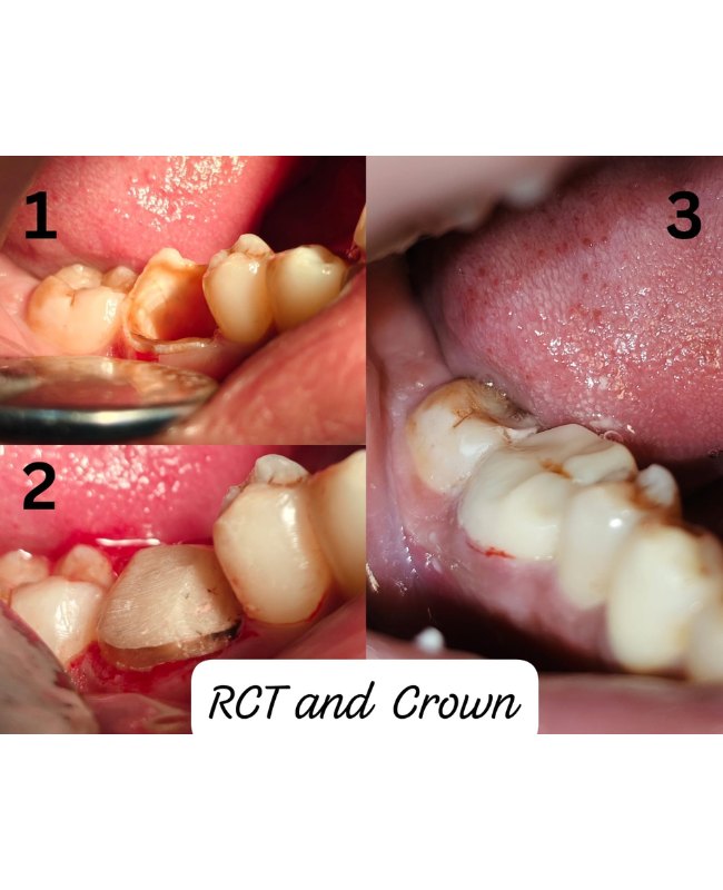 Before and after Dental Crown treatment at Face-O-Max