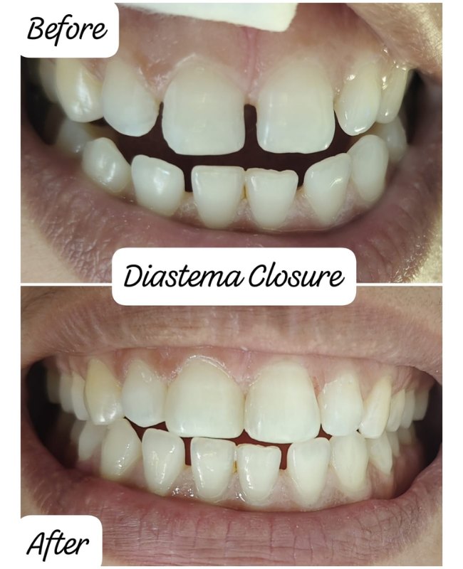 Before and after Diastema Closure treatment at Face-O-Max