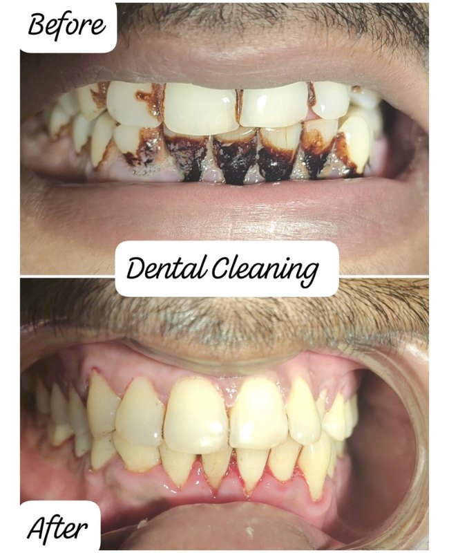 Before and after Oral Prophylaxis treatment at Face-O-Max