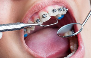 Braces