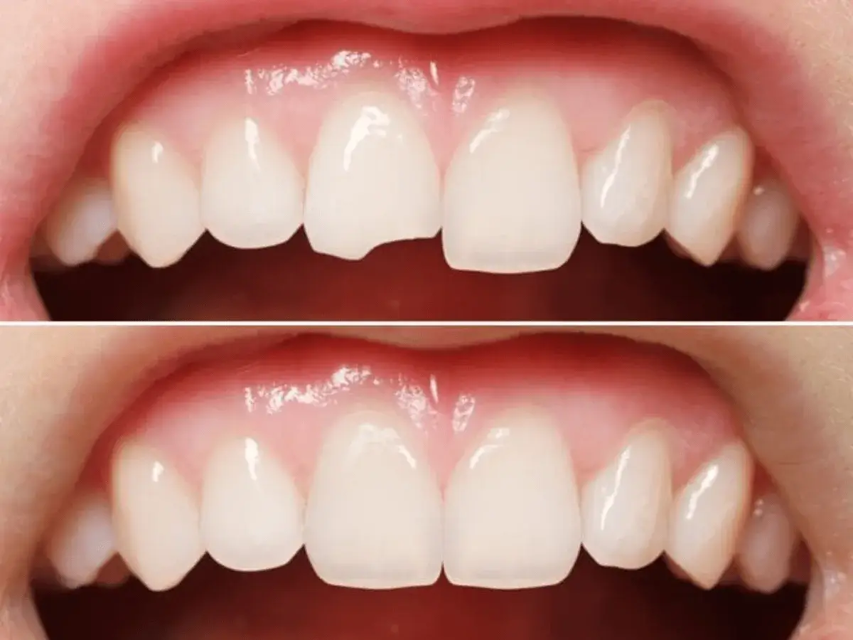 Broken Tooth Repair