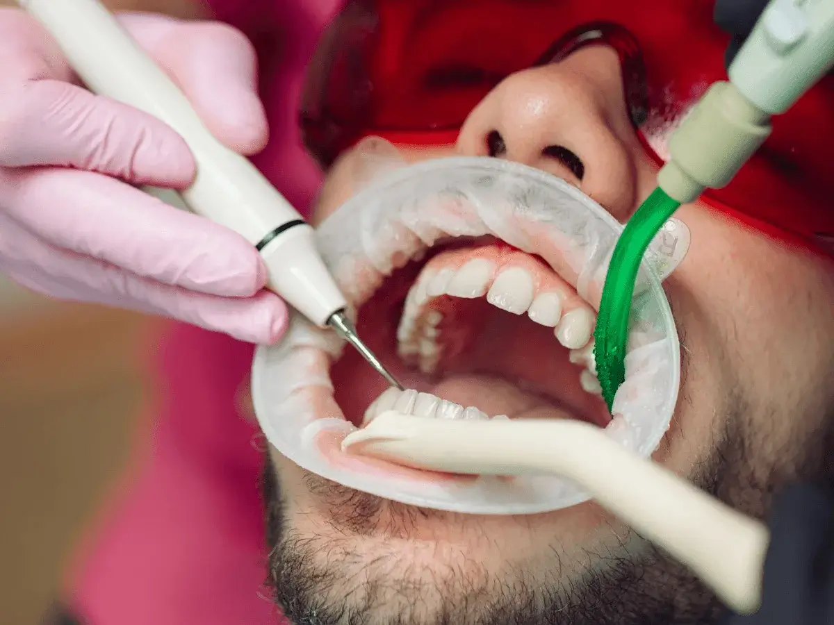 Teeth Cleaning (Scaling)
