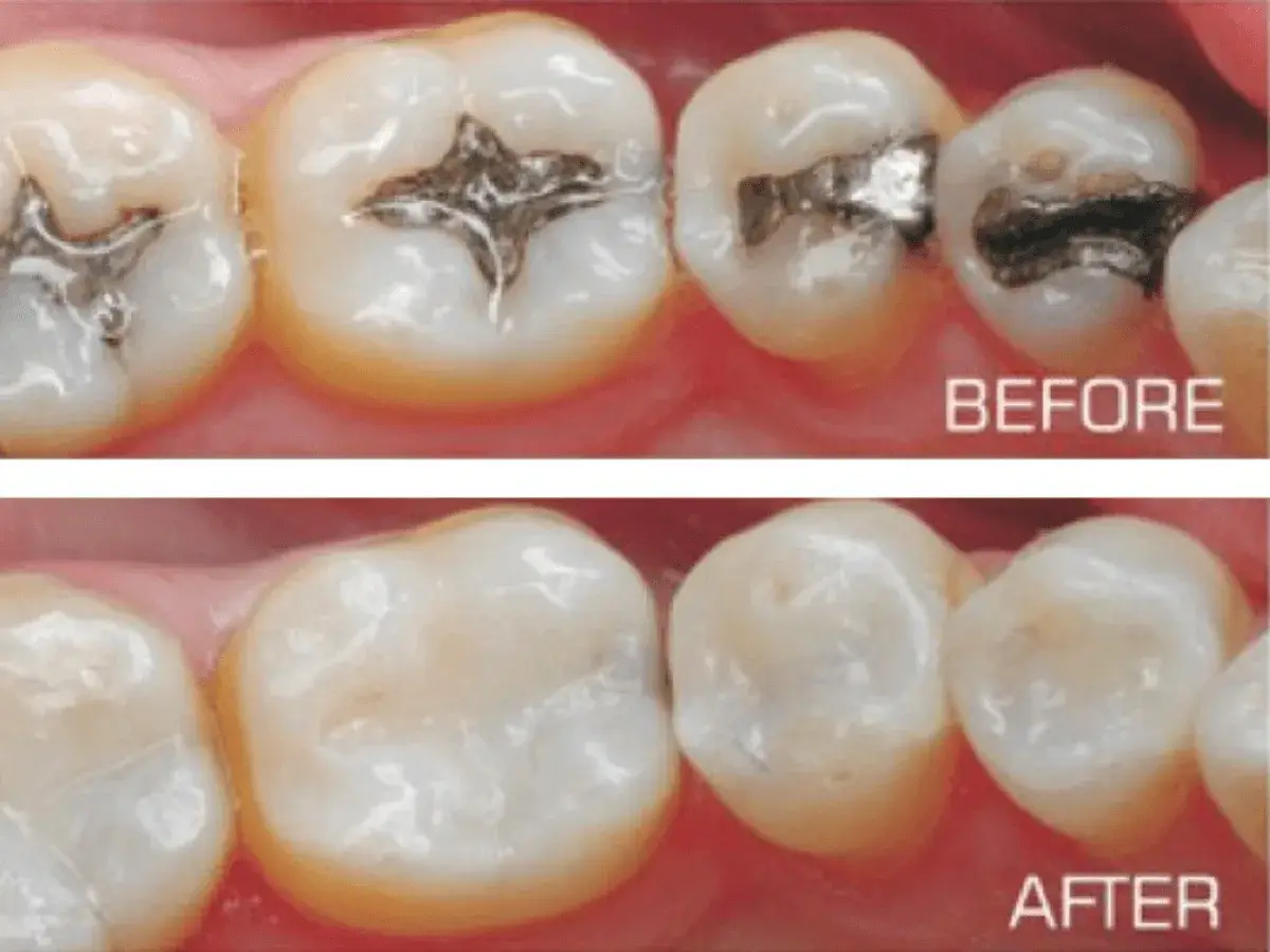 Tooth-Coloured Fillings