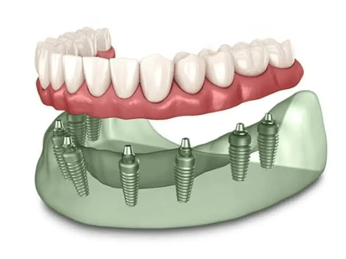 Fixed Teeth (Full-Mouth)
