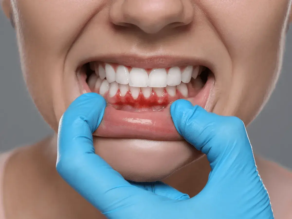 Gum Treatment