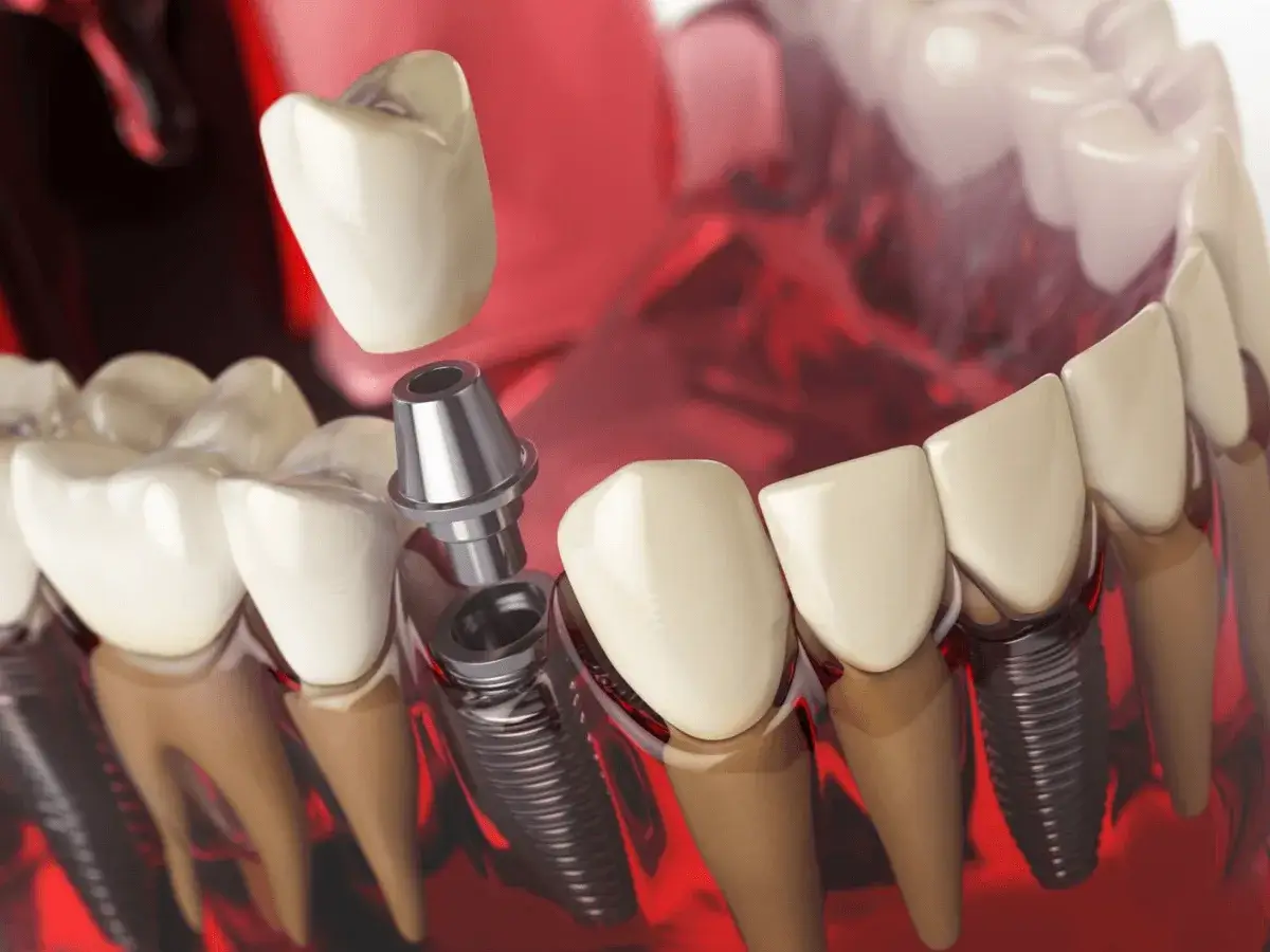 Dental Implants