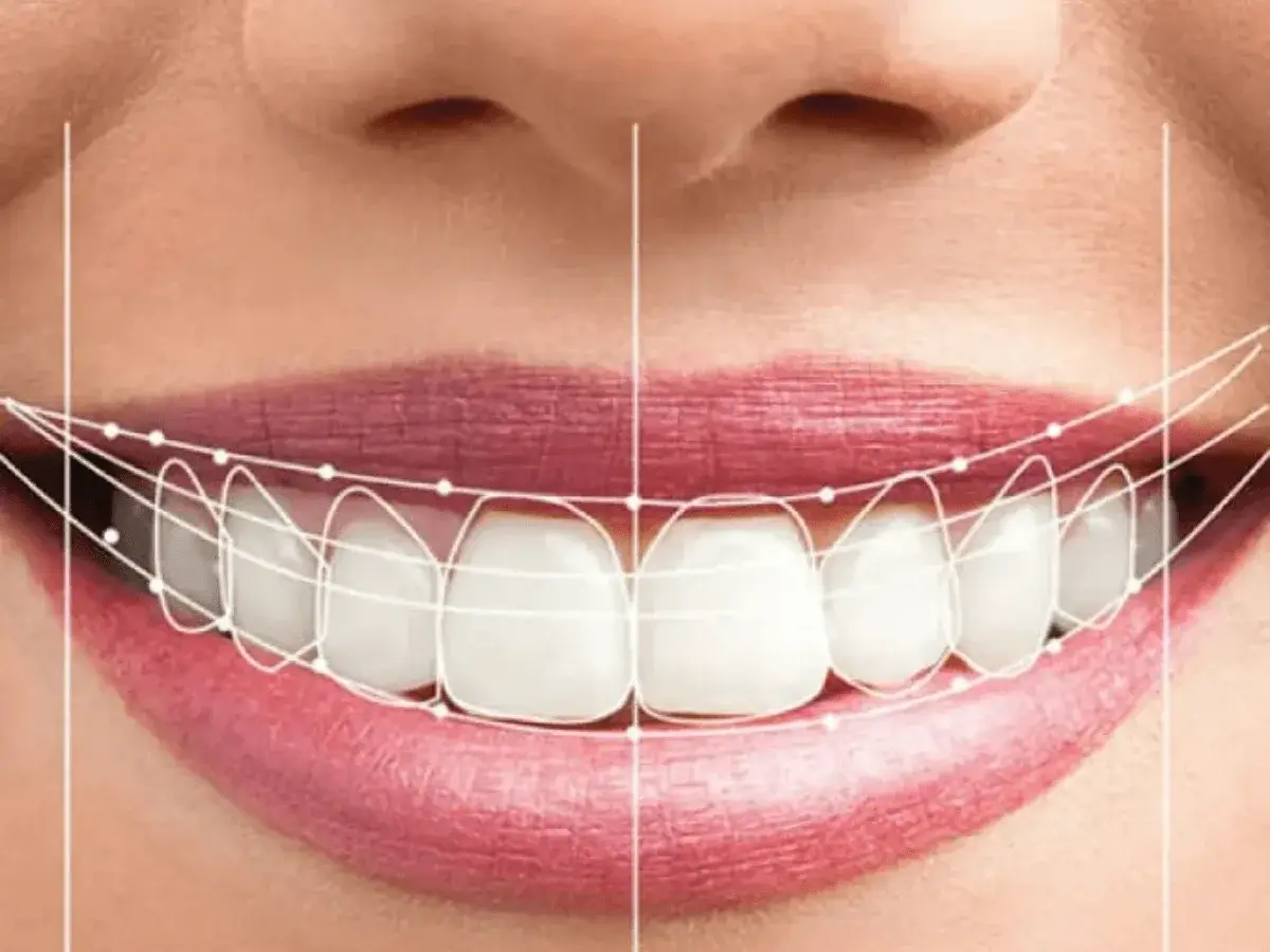 Smile Designing