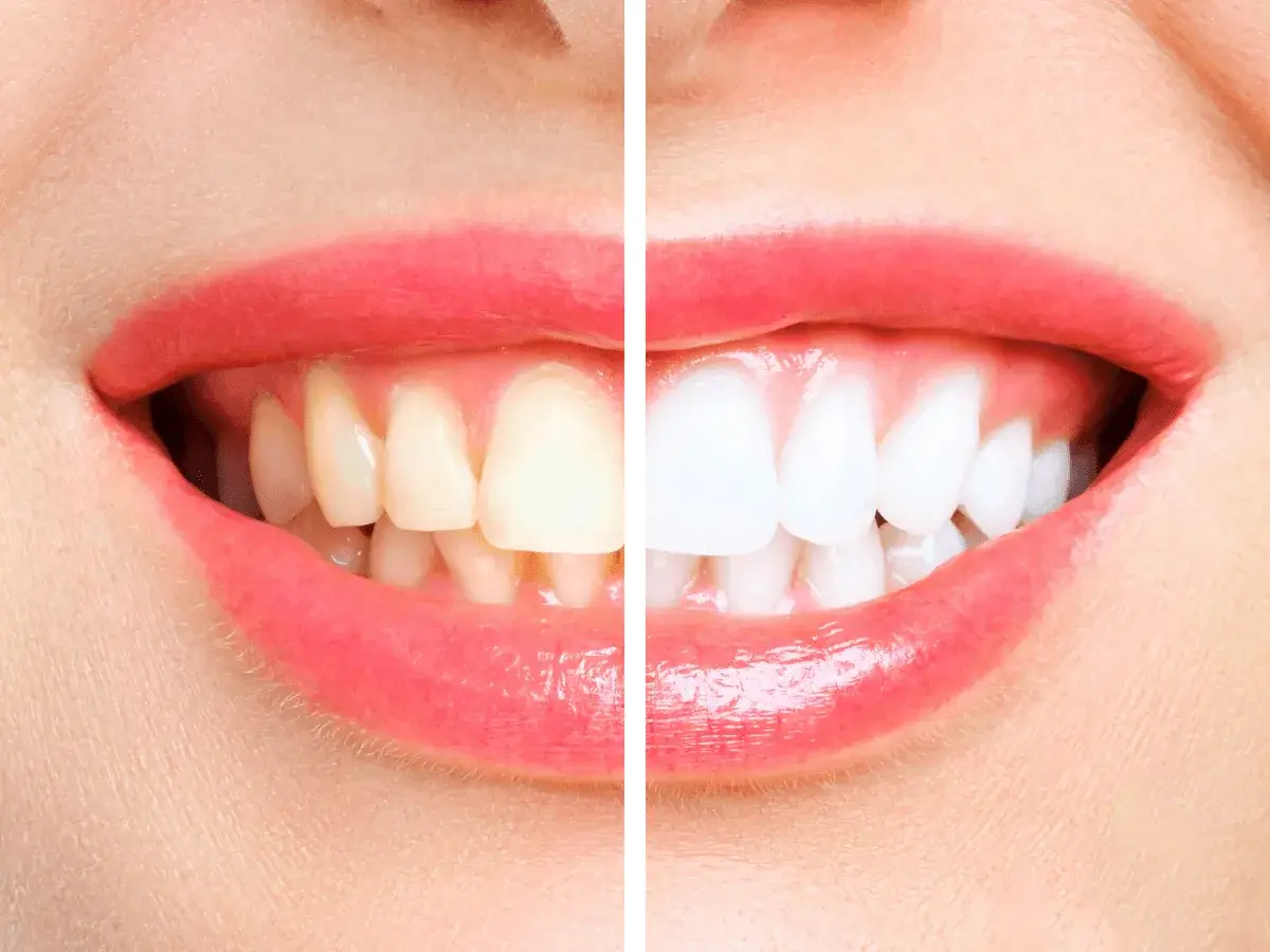Teeth Whitening