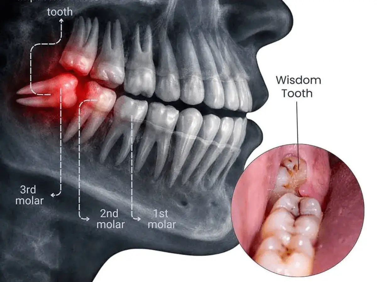 Wisdom Tooth Removal